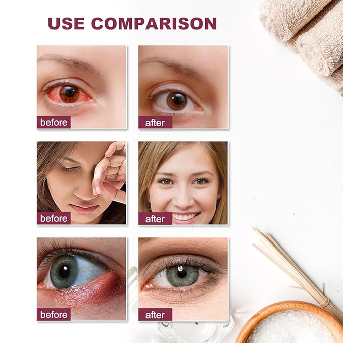 Stye eye treatment,chalazion remover,stye eye