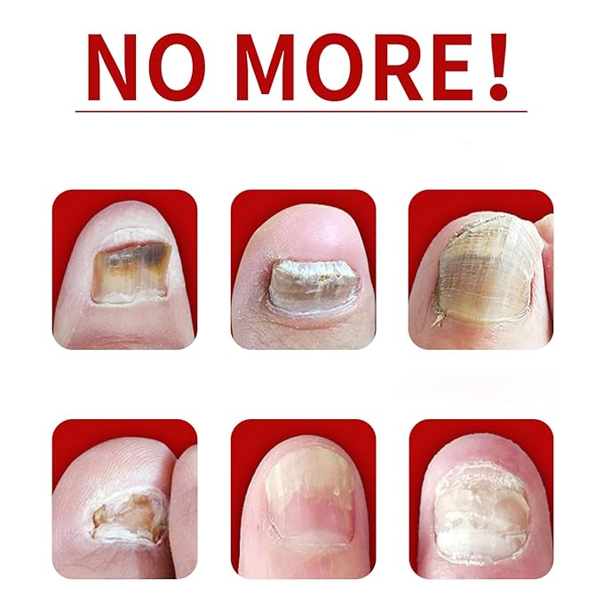 Ginger Nail Treatment Nail Support