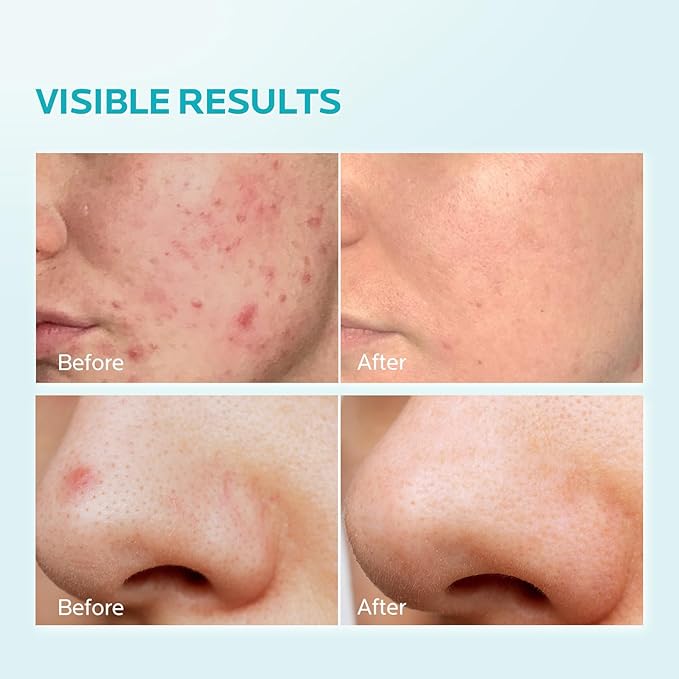 ZealSea Azelaic Acid 10% Facial Cream for Redness Relief Face Skin Care, Pimple Pigmentation Blackhead, Balance Excess Sebum, Clarify Skin, Soothe Irritation,1 Oz, Pack of 2