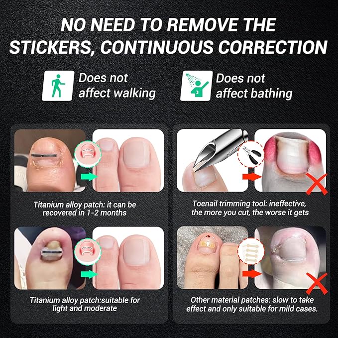 Titanium alloy ingrown toenail treatment-